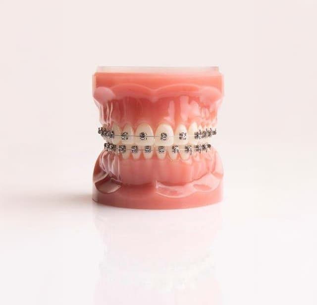 Illustratie van een volledig gebit met een metalen beugel.